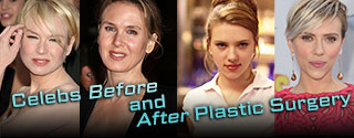 Celebs Before and After Plastic Surgery