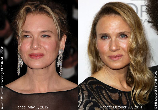 Experts There S No Question Renee Zellweger Had Plastic Surgery Celebrity Gossip And Movie News
