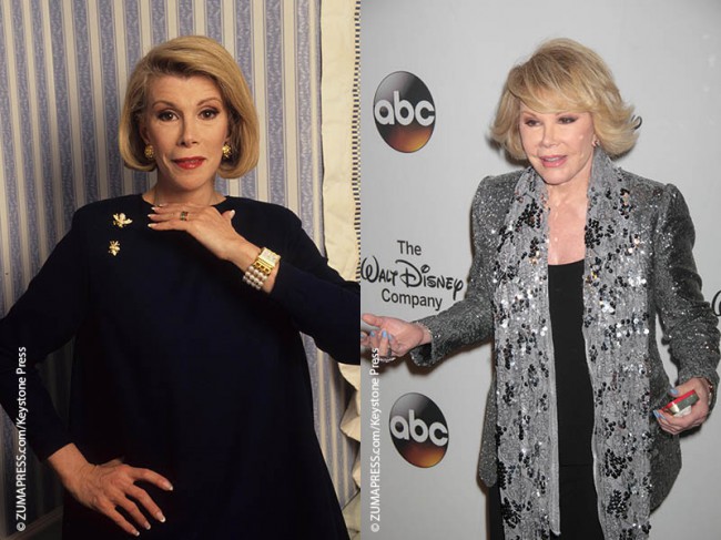 Joan Rivers was plastic surgery. When patients are asked to provide an example of who they want to look like after undergoing plastic surgery, her name is most frequently brought up as someone they DON’T want to look like. Wind-swept face, pinched nose, frozen forehead. She admitted to having Botox injections, fillers, liposuctions, a few […]